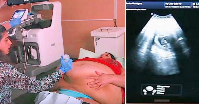 Trudna žena ima 226 kilograma i došla je na ultrazvuk, a onda je medicinska sestra podigla njen stomak i pogledala bolje… (VIDEO) - featured image