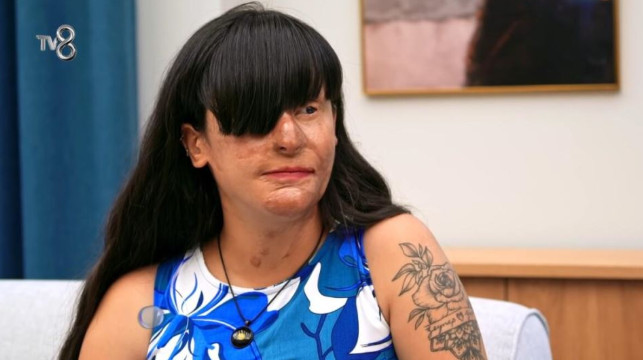 Posle raskida je polio kiselinom, oslepeo na jedno oko i unakazio joj lice, a ona nakon 2 godine u tajnosti donela šok odluku: “Borio sam se za nju godinama…” - featured image