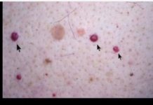 IMATE LI OVE CRVENE TAČKICE NA TIJELU? To nisu popucali kapilari, evo o čemu je zaista riječ