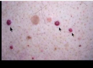 IMATE LI OVE CRVENE TAČKICE NA TIJELU? To nisu popucali kapilari, evo o čemu je zaista riječ