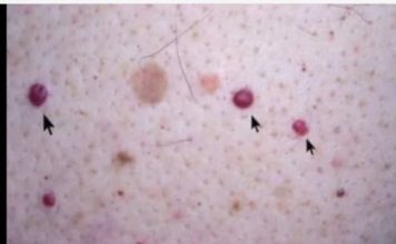 IMATE LI OVE CRVENE TAČKICE NA TIJELU? To nisu popucali kapilari, evo o čemu je zaista riječ