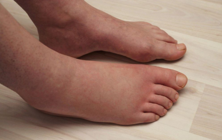 NAJVAŽNIJI vitamin za otklanjanje otoka ruku, nogu i stopala! - featured image