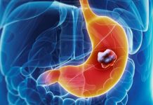 5 ranih simptoma raka želuca: Tumor može da raste godinama, a svi pacijenti prvo osjete ovo 5 ranih simptoma raka želuca: Tumor može da raste godinama, a svi pacijenti prvo osjete ovo - featured image