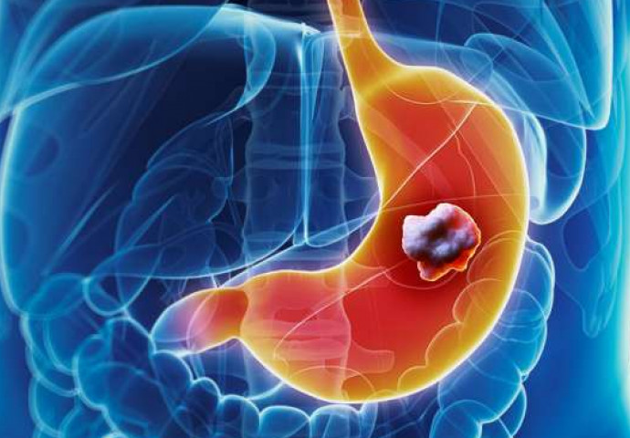 5 ranih simptoma raka želuca: Tumor može da raste godinama, a svi pacijenti prvo osjete ovo - featured image 5 ranih simptoma raka želuca: Tumor može da raste godinama, a svi pacijenti prvo osjete ovo - featured image