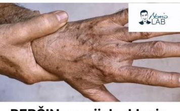 PERŠIN Zauvijek Uklanja STARAČKE MRLJE! Ovo Morate Napraviti… PERŠIN Zauvijek Uklanja STARAČKE MRLJE! Ovo Morate Napraviti… - featured image