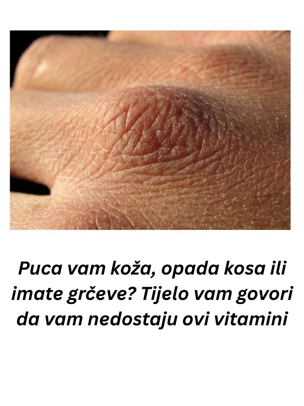 Puca vam koža, opada kosa ili imate grčeve? Tijelo vam govori da vam nedostaju ovi vitamini - featured image
