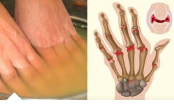 Bolovi u zglobovima ruku i nogu simptomi i lečenje Bolovi u zglobovima ruku i nogu simptomi i lečenje - featured image