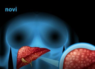 Ovo su 3 simptoma koja ukazuju na moguće probleme s jetrom Ovo su 3 simptoma koja ukazuju na moguće probleme s jetrom - featured image