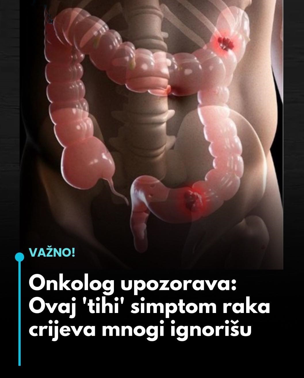 ONKOLOG UPOZORAVA: Ovaj ‘tihi’ simptom raka crijeva mnogi ignorišu… - featured image