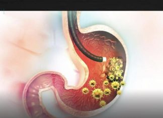 5 ranih simptoma raka želuca: Tumor može da raste godinama, a svi pacijenti prvo osjete ovo… 5 ranih simptoma raka želuca: Tumor može da raste godinama, a svi pacijenti prvo osjete ovo… - featured image