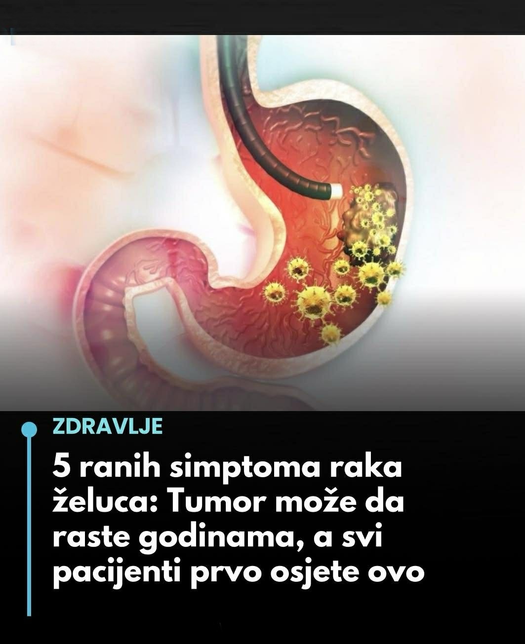 5 ranih simptoma raka želuca: Tumor može da raste godinama, a svi pacijenti prvo osjete ovo… - featured image