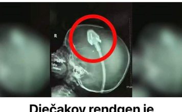 Dječakov rendgen je šokirao doktore diljem svijeta: Sad njegovi roditelji upozoravaju druge! (VIDEO) Dječakov rendgen je šokirao doktore diljem svijeta: Sad njegovi roditelji upozoravaju druge! (VIDEO) - featured image