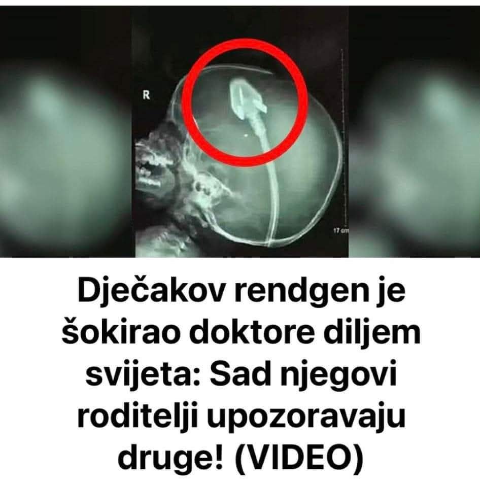 Dječakov rendgen je šokirao doktore diljem svijeta: Sad njegovi roditelji upozoravaju druge! (VIDEO) - featured image Dječakov rendgen je šokirao doktore diljem svijeta: Sad njegovi roditelji upozoravaju druge! (VIDEO) - featured image