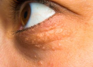 STAVILA SAM OVU NAMIRNICU NA MASNO TKIVO KOD OKA, ono je preko noći nestalo: EVO ŠTA ME SPASILO, SVI GA IMATE U KUĆI STAVILA SAM OVU NAMIRNICU NA MASNO TKIVO KOD OKA, ono je preko noći nestalo: EVO ŠTA ME SPASILO, SVI GA IMATE U KUĆI - featured image