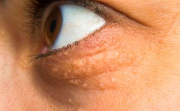 STAVILA SAM OVU NAMIRNICU NA MASNO TKIVO KOD OKA, ono je preko noći nestalo: EVO ŠTA ME SPASILO, SVI GA IMATE U KUĆI STAVILA SAM OVU NAMIRNICU NA MASNO TKIVO KOD OKA, ono je preko noći nestalo: EVO ŠTA ME SPASILO, SVI GA IMATE U KUĆI - featured image