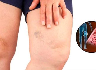 Simptomi krvnih ugrušaka u tijelu: Ako to primijetite, odmah potražite medicinsku pomoć Simptomi krvnih ugrušaka u tijelu: Ako to primijetite, odmah potražite medicinsku pomoć - featured image