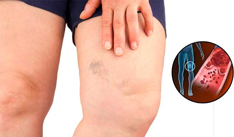 Simptomi krvnih ugrušaka u tijelu: Ako to primijetite, odmah potražite medicinsku pomoć - featured image