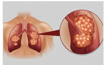 PUŠAČI, PAŽNJA! Za 3 dana izbacite sve otrove iz tijela: Ova metoda skida OTROV SA ZIDOVA PLUĆA, sprečava rak, izbacuje masnoće i višak vode! PUŠAČI, PAŽNJA! Za 3 dana izbacite sve otrove iz tijela: Ova metoda skida OTROV SA ZIDOVA PLUĆA, sprečava rak, izbacuje masnoće i višak vode! - featured image