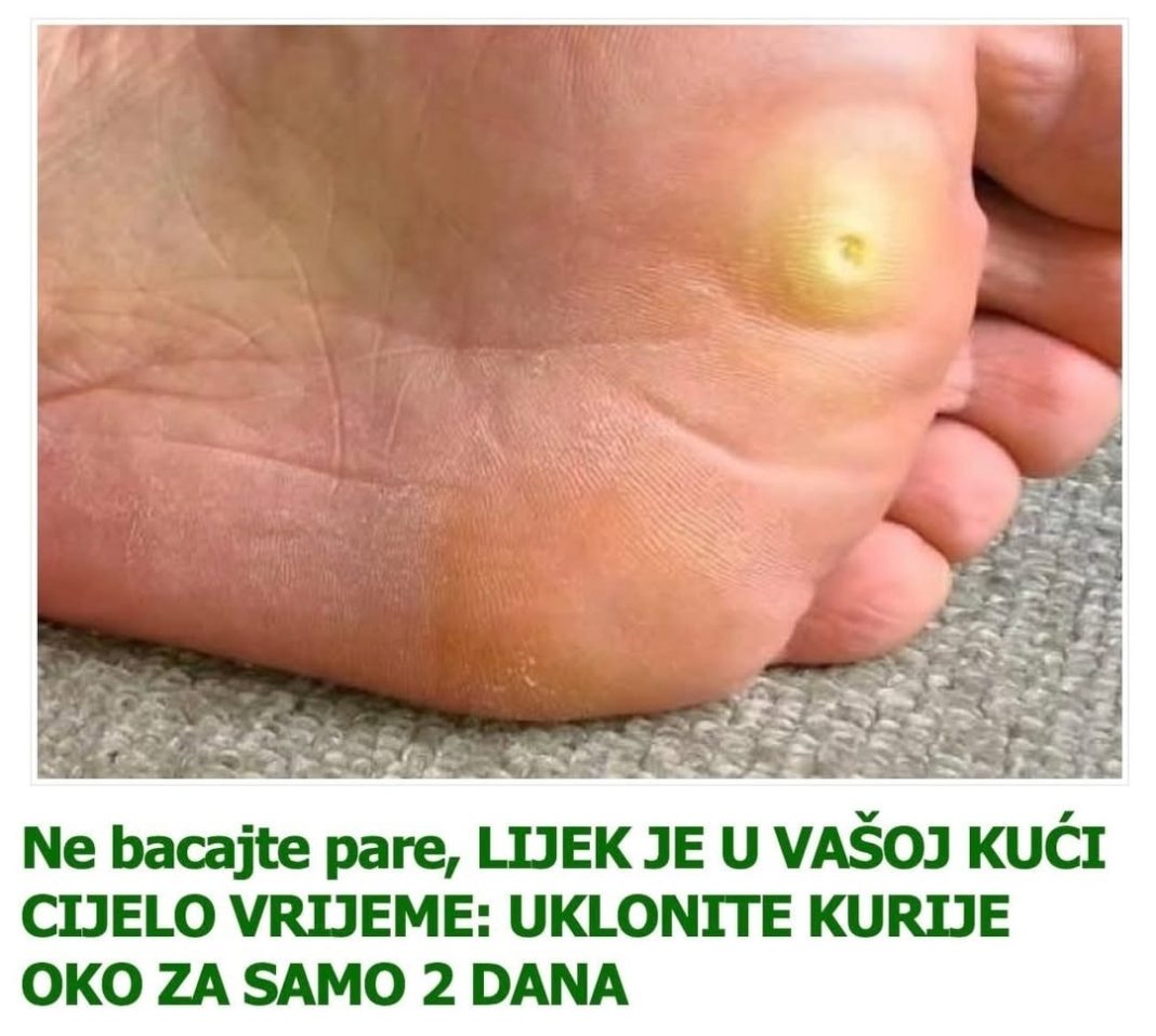 Svekrvi je na stopalu iskočilo kurje oko, nije mogla da hoda: a onda sam joj rekla da privije ovu biljku, nestalo je preko noći… - featured image Svekrvi je na stopalu iskočilo kurje oko, nije mogla da hoda: a onda sam joj rekla da privije ovu biljku, nestalo je preko noći… - featured image