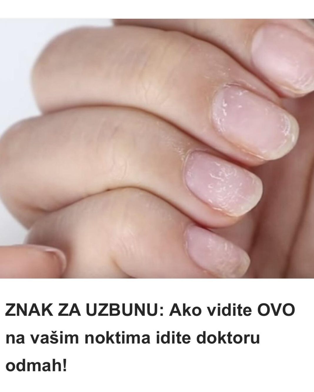 ZNAK ZA UZBUNU: Ako vidite OVO na vašim noktima idite doktoru odmah! - featured image