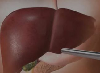 OVA HRANA UNIŠTAVA JETRU SKORO ISTO KOLIKO I ALKOHOL: 5 namirnica čiji unos morate ograničiti OVA HRANA UNIŠTAVA JETRU SKORO ISTO KOLIKO I ALKOHOL: 5 namirnica čiji unos morate ograničiti - featured image