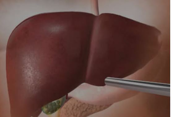 OVA HRANA UNIŠTAVA JETRU SKORO ISTO KOLIKO I ALKOHOL: 5 namirnica čiji unos morate ograničiti - featured image