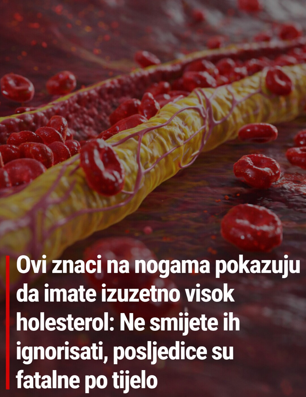 Ovi znaci na nogama pokazuju da imate izuzetno visok holesterol: Ne smijete ih ignorisati, posljedice su fatalne po tijelo - featured image