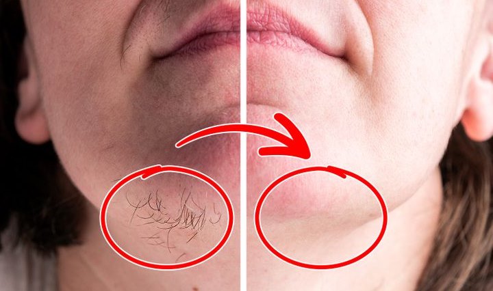 SVAKA ŽENA ZASLUŽUJE DA OVO ZNA: Prirodnim putem uklonite brkove i druge neželjene dlačice sa tijela zauvijek - featured image