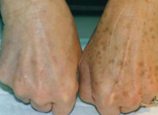 PRIMJETILI STE DA VAM SE POJAVLJUJU STARAČKE PJEGE : To je znak da imate ozbiljan problem sa jednim organom! PRIMJETILI STE DA VAM SE POJAVLJUJU STARAČKE PJEGE : To je znak da imate ozbiljan problem sa jednim organom! - featured image