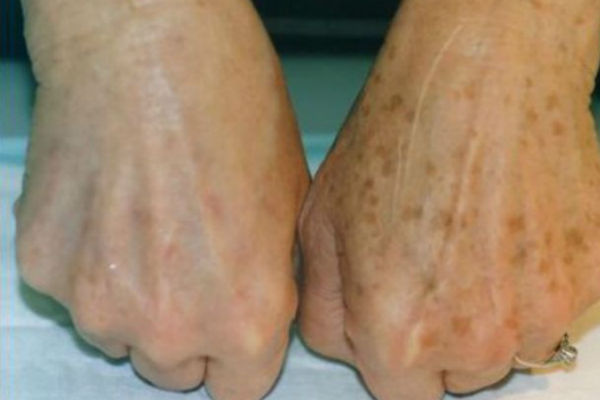 PRIMJETILI STE DA VAM SE POJAVLJUJU STARAČKE PJEGE : To je znak da imate ozbiljan problem sa jednim organom! - featured image PRIMJETILI STE DA VAM SE POJAVLJUJU STARAČKE PJEGE : To je znak da imate ozbiljan problem sa jednim organom! - featured image