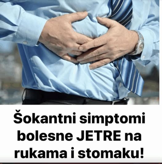 Šokantni simptomi bolesne JETRE na rukama i stomaku - featured image