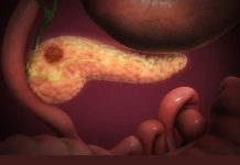 OVA 4 SIMPTOMA UKAZUJU DA IMATE RAK PANKREASA! Svrab je jedan od njih – a tek da čujete ostala tri OVA 4 SIMPTOMA UKAZUJU DA IMATE RAK PANKREASA! Svrab je jedan od njih – a tek da čujete ostala tri - featured image