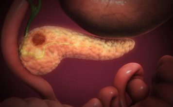 OVA 4 SIMPTOMA UKAZUJU DA IMATE RAK PANKREASA! Svrab je jedan od njih – a tek da čujete ostala tri OVA 4 SIMPTOMA UKAZUJU DA IMATE RAK PANKREASA! Svrab je jedan od njih – a tek da čujete ostala tri - featured image