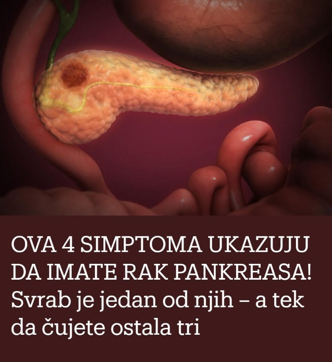 OVA 4 SIMPTOMA UKAZUJU DA IMATE RAK PANKREASA! Svrab je jedan od njih – a tek da čujete ostala tri - featured image OVA 4 SIMPTOMA UKAZUJU DA IMATE RAK PANKREASA! Svrab je jedan od njih – a tek da čujete ostala tri - featured image