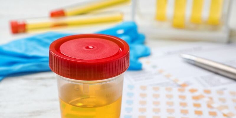 BOJA URINA otkriva mnoge ozbiljne bolesti, pa čak i one NAJTEŽE – Ovo je RAZLOG zbog kog vam je MOKRAĆA MUTNA - featured image