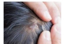 BUBULJICE NA GLAVI SU SVE ČEŠĆI PROBLEM: Ni slučajno ih ne istiskujte, evo zašto se javljaju I ŠTA TREBATE URADITI DA NESTANU BUBULJICE NA GLAVI SU SVE ČEŠĆI PROBLEM: Ni slučajno ih ne istiskujte, evo zašto se javljaju I ŠTA TREBATE URADITI DA NESTANU - featured image