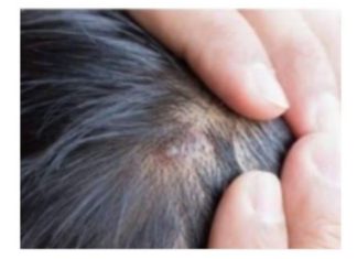 BUBULJICE NA GLAVI SU SVE ČEŠĆI PROBLEM: Ni slučajno ih ne istiskujte, evo zašto se javljaju I ŠTA TREBATE URADITI DA NESTANU BUBULJICE NA GLAVI SU SVE ČEŠĆI PROBLEM: Ni slučajno ih ne istiskujte, evo zašto se javljaju I ŠTA TREBATE URADITI DA NESTANU - featured image