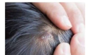 BUBULJICE NA GLAVI SU SVE ČEŠĆI PROBLEM: Ni slučajno ih ne istiskujte, evo zašto se javljaju I ŠTA TREBATE URADITI DA NESTANU BUBULJICE NA GLAVI SU SVE ČEŠĆI PROBLEM: Ni slučajno ih ne istiskujte, evo zašto se javljaju I ŠTA TREBATE URADITI DA NESTANU - featured image