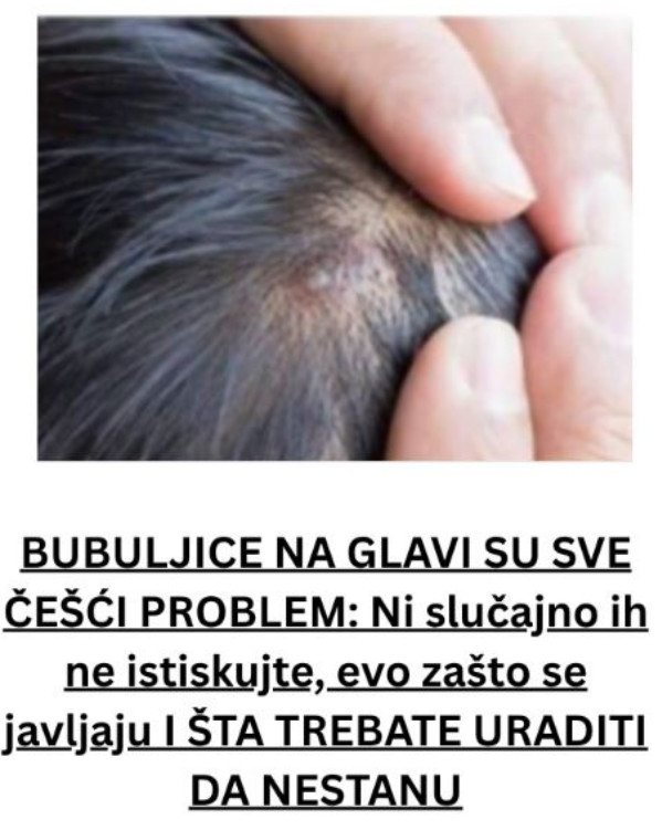 BUBULJICE NA GLAVI SU SVE ČEŠĆI PROBLEM: Ni slučajno ih ne istiskujte, evo zašto se javljaju I ŠTA TREBATE URADITI DA NESTANU - featured image