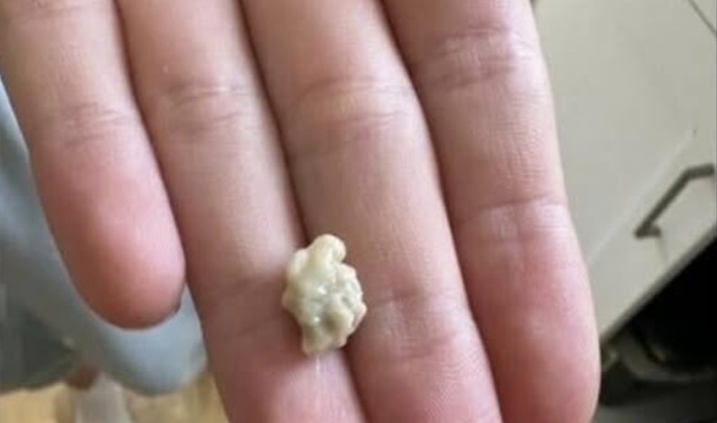 “Neočekivano i šokantno iskustvo: Ono što je izašlo iz mog grla će vas ostaviti bez riječi 😳” - featured image