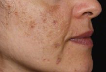 Evo kako da sa ovim jednostavnim trikom od 2 sastojka izbrišete mrlje s kože! Evo kako da sa ovim jednostavnim trikom od 2 sastojka izbrišete mrlje s kože! - featured image