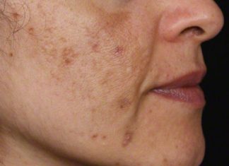 Evo kako da sa ovim jednostavnim trikom od 2 sastojka izbrišete mrlje s kože! Evo kako da sa ovim jednostavnim trikom od 2 sastojka izbrišete mrlje s kože! - featured image