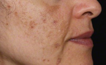 Evo kako da sa ovim jednostavnim trikom od 2 sastojka izbrišete mrlje s kože! Evo kako da sa ovim jednostavnim trikom od 2 sastojka izbrišete mrlje s kože! - featured image