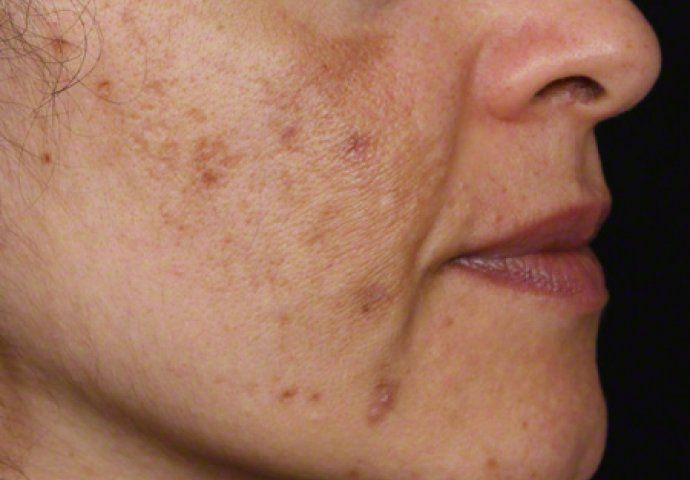 Evo kako da sa ovim jednostavnim trikom od 2 sastojka izbrišete mrlje s kože! - featured image