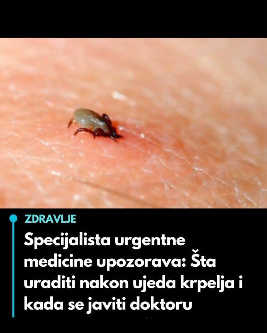 Specijalista urgentne medicine upozorava: Šta uraditi nakon ujeda krpelja i kada se javiti doktoru - featured image