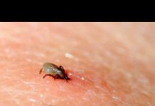 Specijalista urgentne medicine upozorava: Šta uraditi nakon ujeda krpelja i kada se javiti doktoru Specijalista urgentne medicine upozorava: Šta uraditi nakon ujeda krpelja i kada se javiti doktoru - featured image