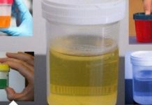 Često mokrite manje količine urina? Noću se budite da idete u wc? Ovo su simptomi jednog sindroma! Evo šta je u pitanju Često mokrite manje količine urina? Noću se budite da idete u wc? Ovo su simptomi jednog sindroma! Evo šta je u pitanju - featured image
