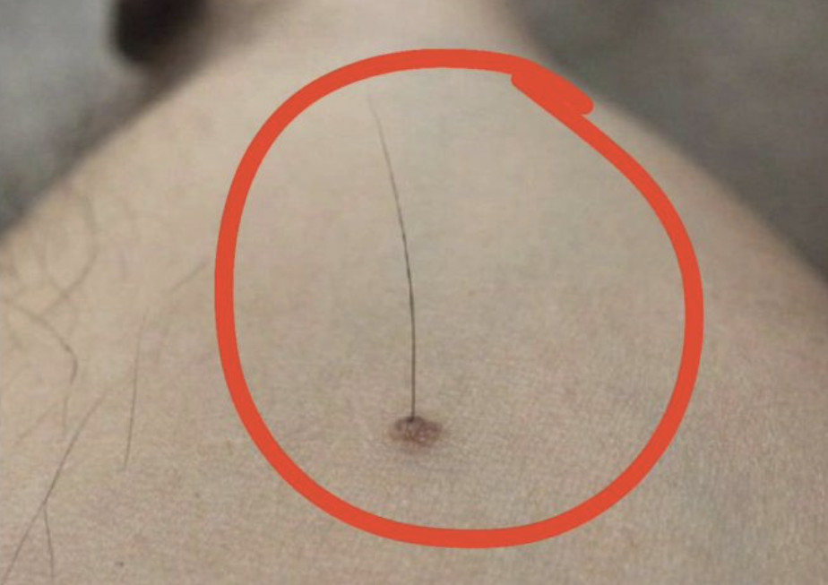 Evo šta tačno znači kada vam iz mladeža raste dlaka: Da li je to opasno, iznenadit ćete se - featured image
