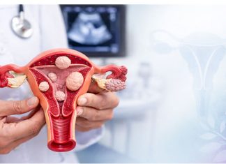 Žene obratite pažnju: Ovo su prvi simptomi mioma materice, obično ih je više, a ovi su najčešći Žene obratite pažnju: Ovo su prvi simptomi mioma materice, obično ih je više, a ovi su najčešći - featured image
