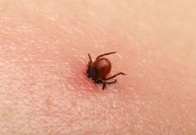 Bezbolno je i nema čupanja: Doktorka otkrila trik kako da se krpelj sam otkači sa kože (video) Bezbolno je i nema čupanja: Doktorka otkrila trik kako da se krpelj sam otkači sa kože (video) - featured image